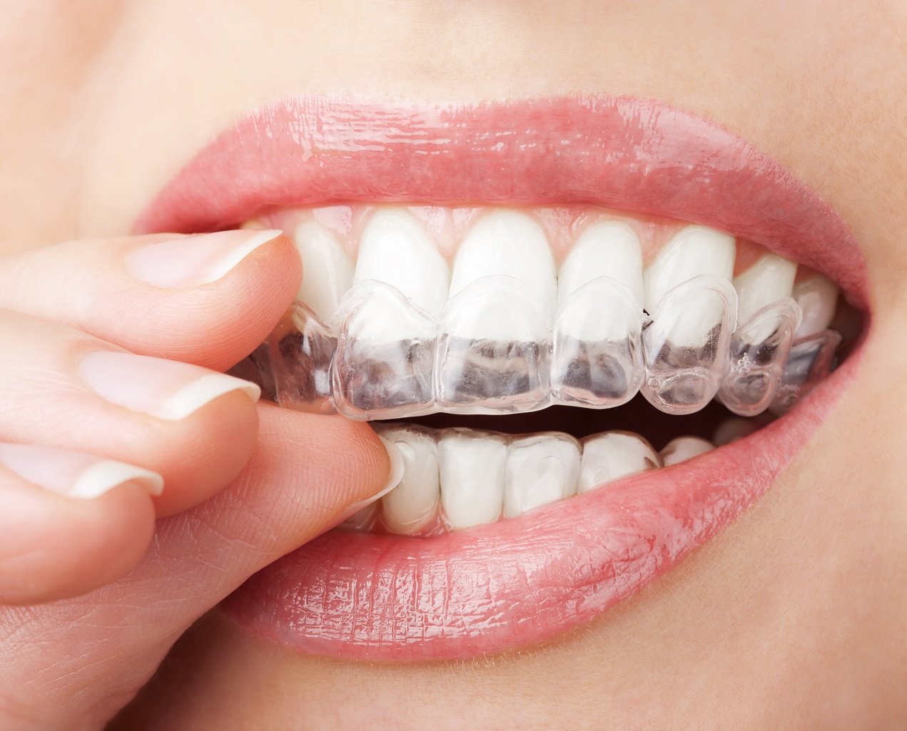 Orthodontic Treatment in Matthews near Charlotte, NC