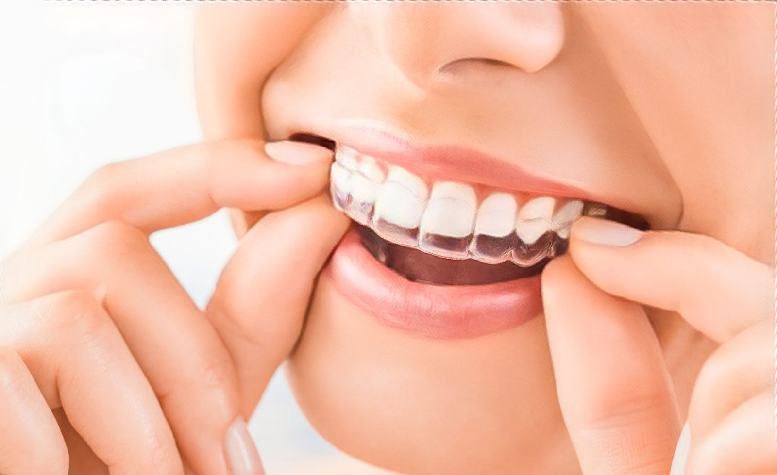 Invisalign clear braces treatment in Matthews near Charlotte, NC
