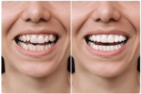 Invisalign treatment before and after